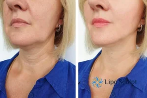 Double chin before and after Hi-Fu treatment 4 Book your double chin treatment Islington today! We are here to help!