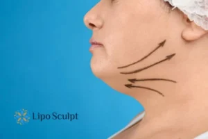 Double chin before and after Hi-Fu treatment 3 Boost your confidence with a Double chin treatment Islington