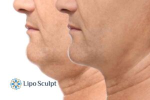 Double chin before and after Hi-Fu treatment 2 Double chin treatment Islington from Lipo Sculpt - feel more confident today!