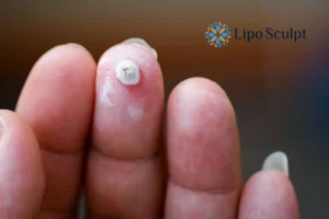 Cryopen Top 5 Treatable Conditions 4 Do you have a persistent wart of verruca that you cannot shit? Cryopen Islington treatment will work call us NOW!