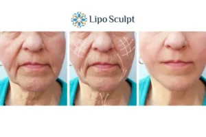 Explaining Morpheus8 And What It Can Do For You 3 Boost your confidence with Morpheus8 Islington call our team today!