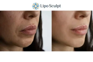 Explaining Morpheus8 And What It Can Do For You 4 Morpheus8 Islington the best results - call our team today!