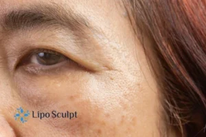 Cryopen: The Revolutionary Treatment for Age Spots Unveiled 2 Are age spots Islington giving you low self esteem? Contact us today!