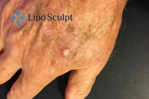 Best Actinic Keratoses Removal 2 Improve your wellbeing and health with Actinic Keratoses Islington removal.treatment