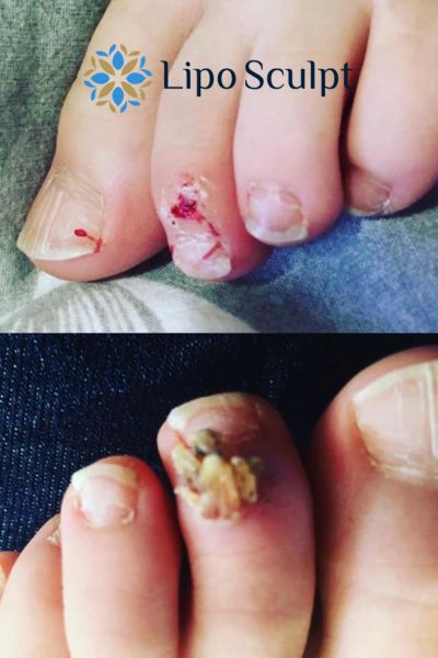 Wart removal customer results from Lipo Sculpt Islington